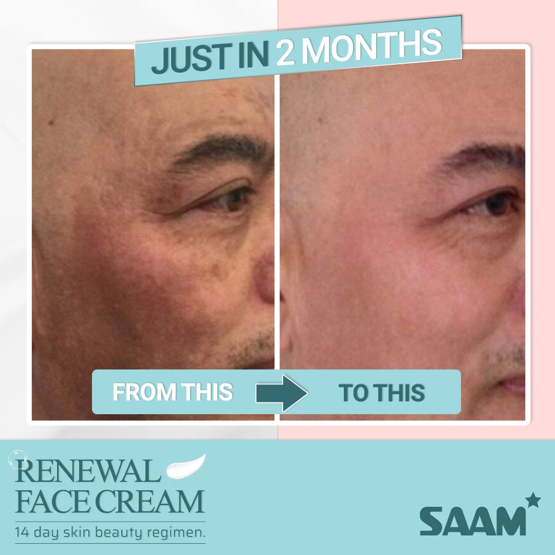 SAAM Renewal Face Cream – 50g for Melasma, Freckles & Pigmentation