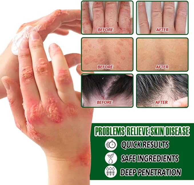 Herbal Psoriasis Cream – Plant Extract Hydrating & Soothing Skin Care (Unisex)