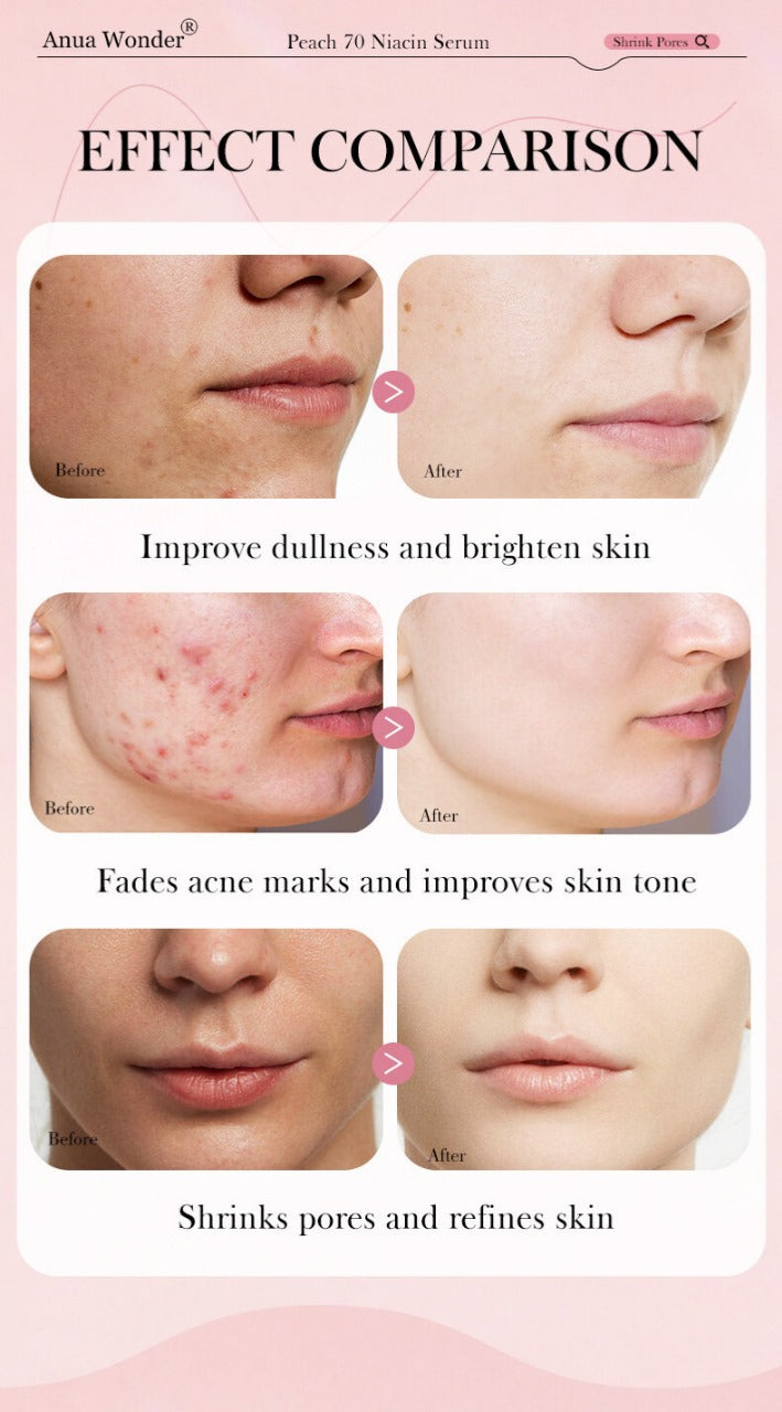 Anua Wonder Peach 70% Niacinamide Serum – Glass Skin Radiance Booster (30 ml)
