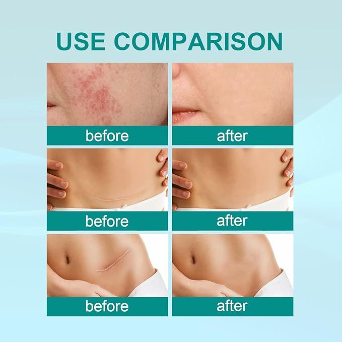 Proregen Medical Scar Removal Spray – Acne & Scar Treatment for Face & Body