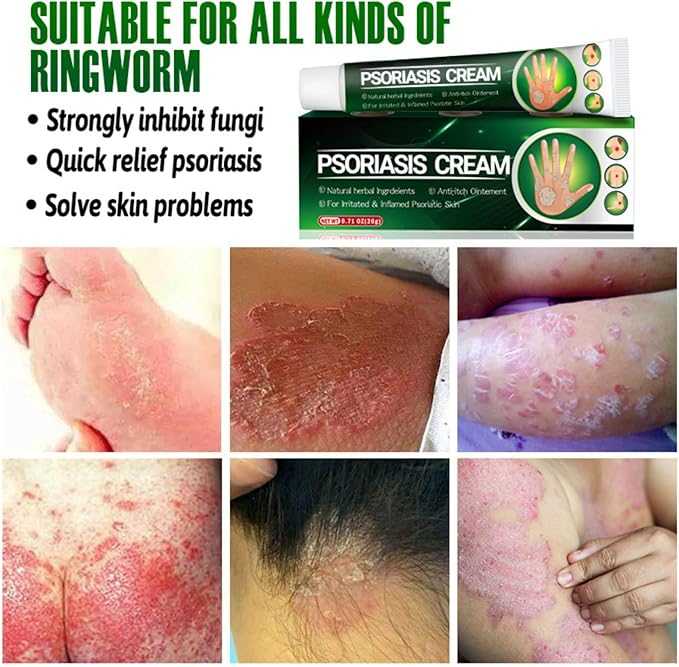 Herbal Psoriasis Cream – Plant Extract Hydrating & Soothing Skin Care (Unisex)