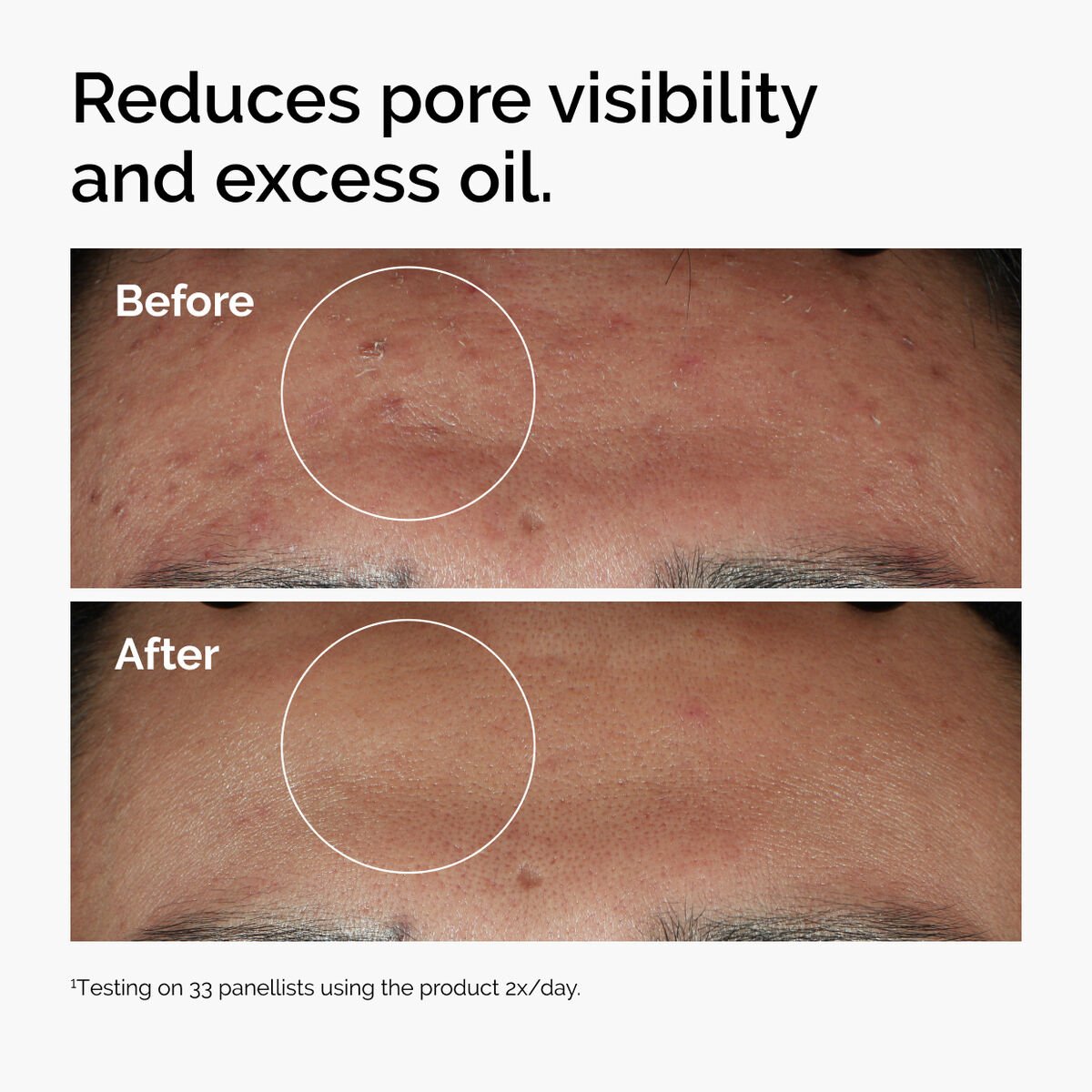The Ordinary Niacinamide 10% + Zinc 1% – 30ml Brightening Serum for Clear, Balanced, and Radiant Skin