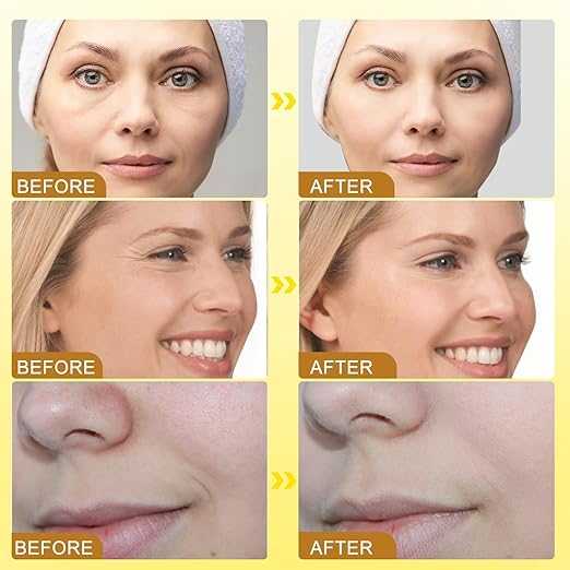 Botox Bee Venom Cream – Anti Aging Bee Venom Wrinkle Removal Face Cream