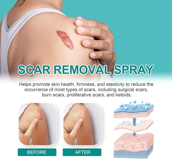 Proregen Medical Scar Removal Spray – Acne & Scar Treatment for Face & Body
