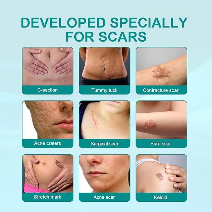 Proregen Medical Scar Removal Spray – Acne & Scar Treatment for Face & Body